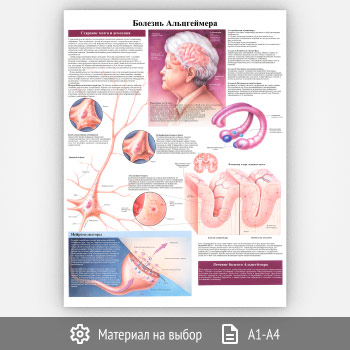 Плакат «Болезнь Альцгеймера» (ЗОЖ-22, 1 лист)